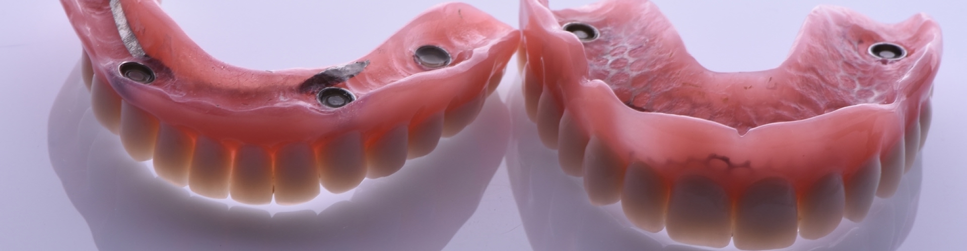Lower and upper implant-retained dentures.